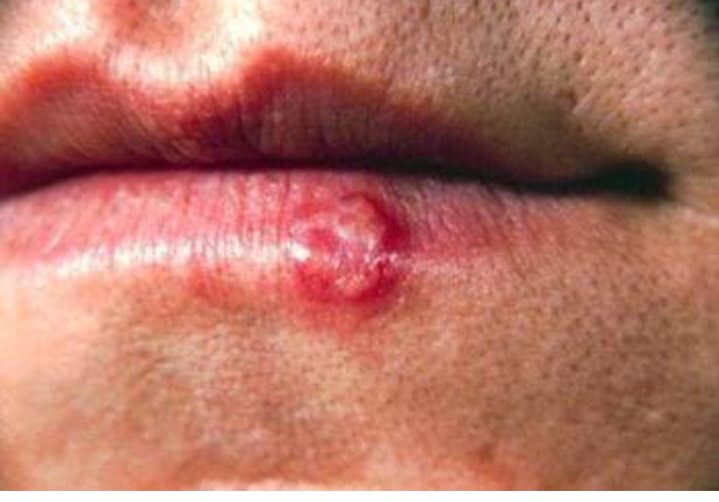 herpes