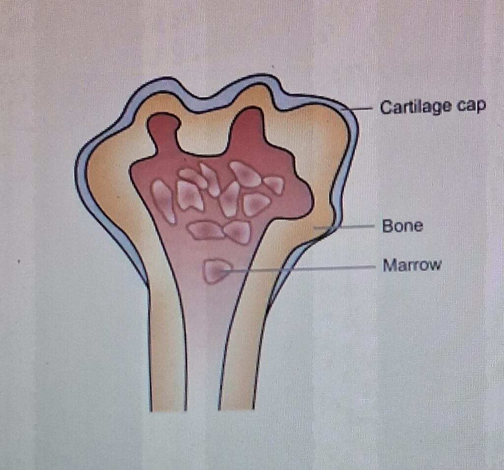 Bone Tumor