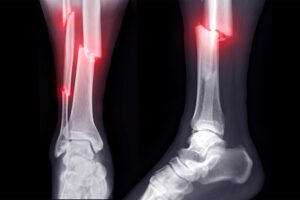 Fracture