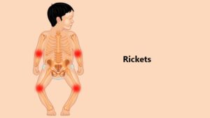 Rickets
