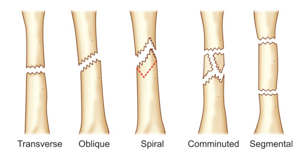 Patterns of fracture ; transverse,oblique,spiral, comminuted fractures.