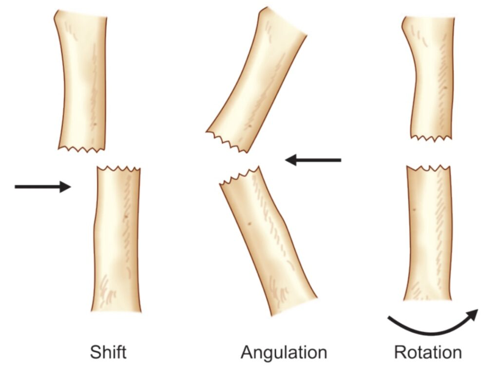 Displaced fracture