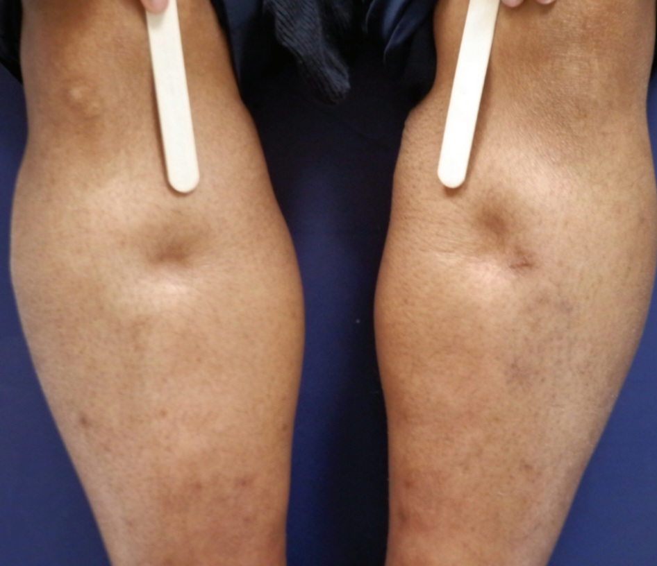 Pitting edema, bilateral, as observed in a patient with congestive heart failure.