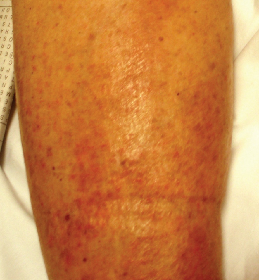 Acute deep venous thrombosis with overlying cellulitis.