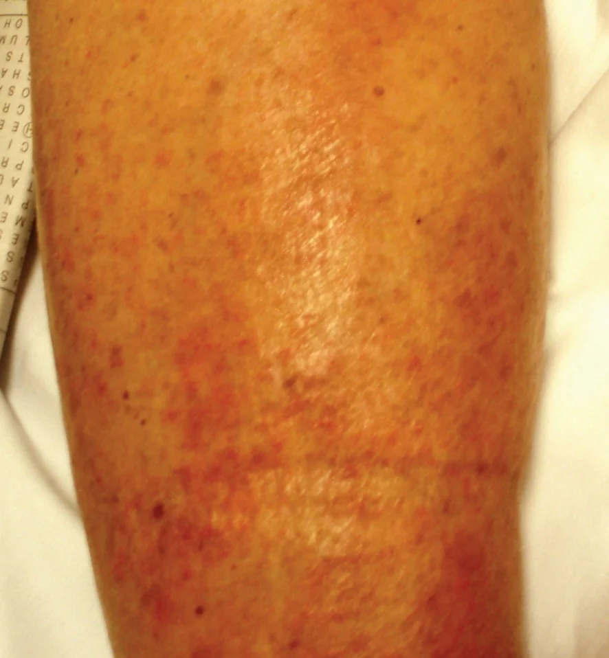 Acute deep venous thrombosis with overlying cellulitis.