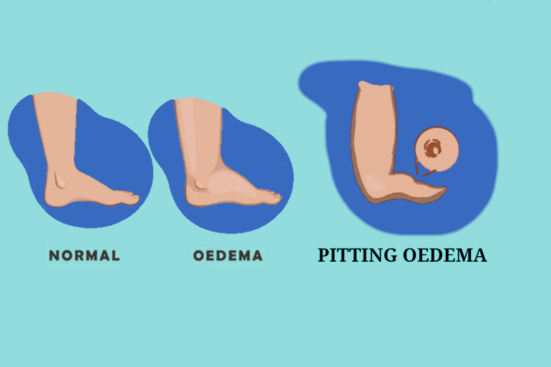 Types of oedema
