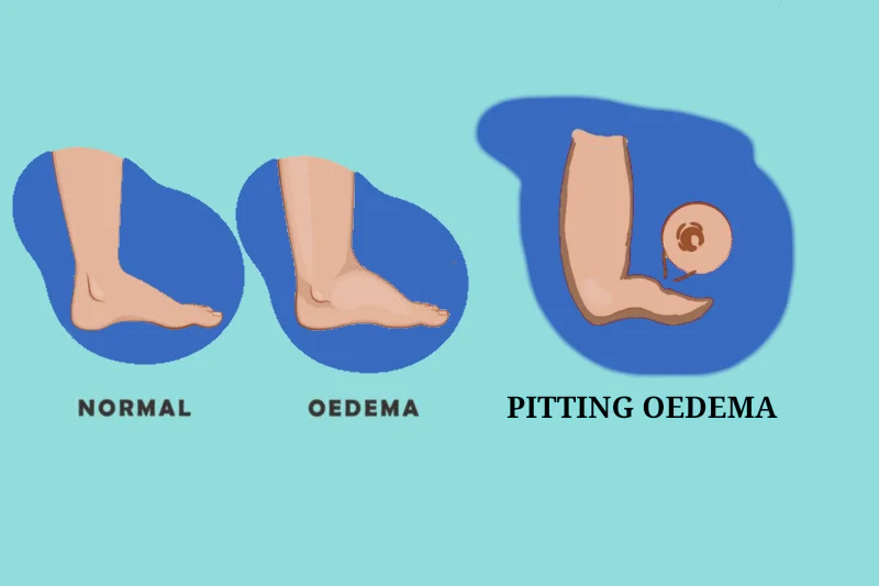 Types of oedema