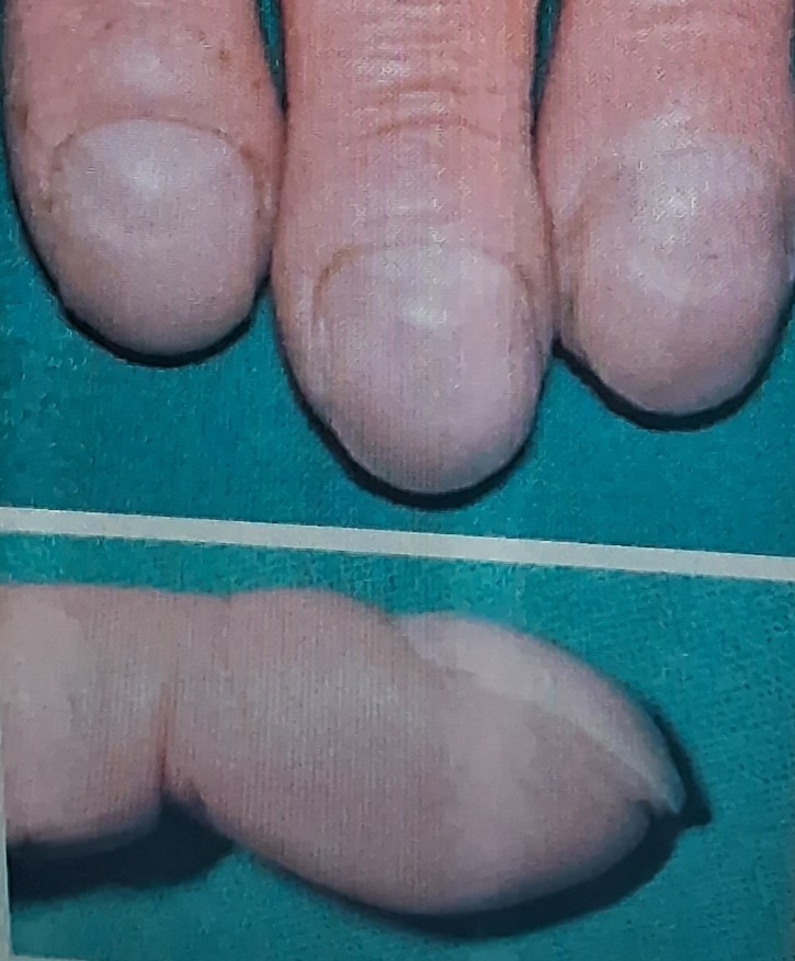 Clubbing of nails : congenital heart disease