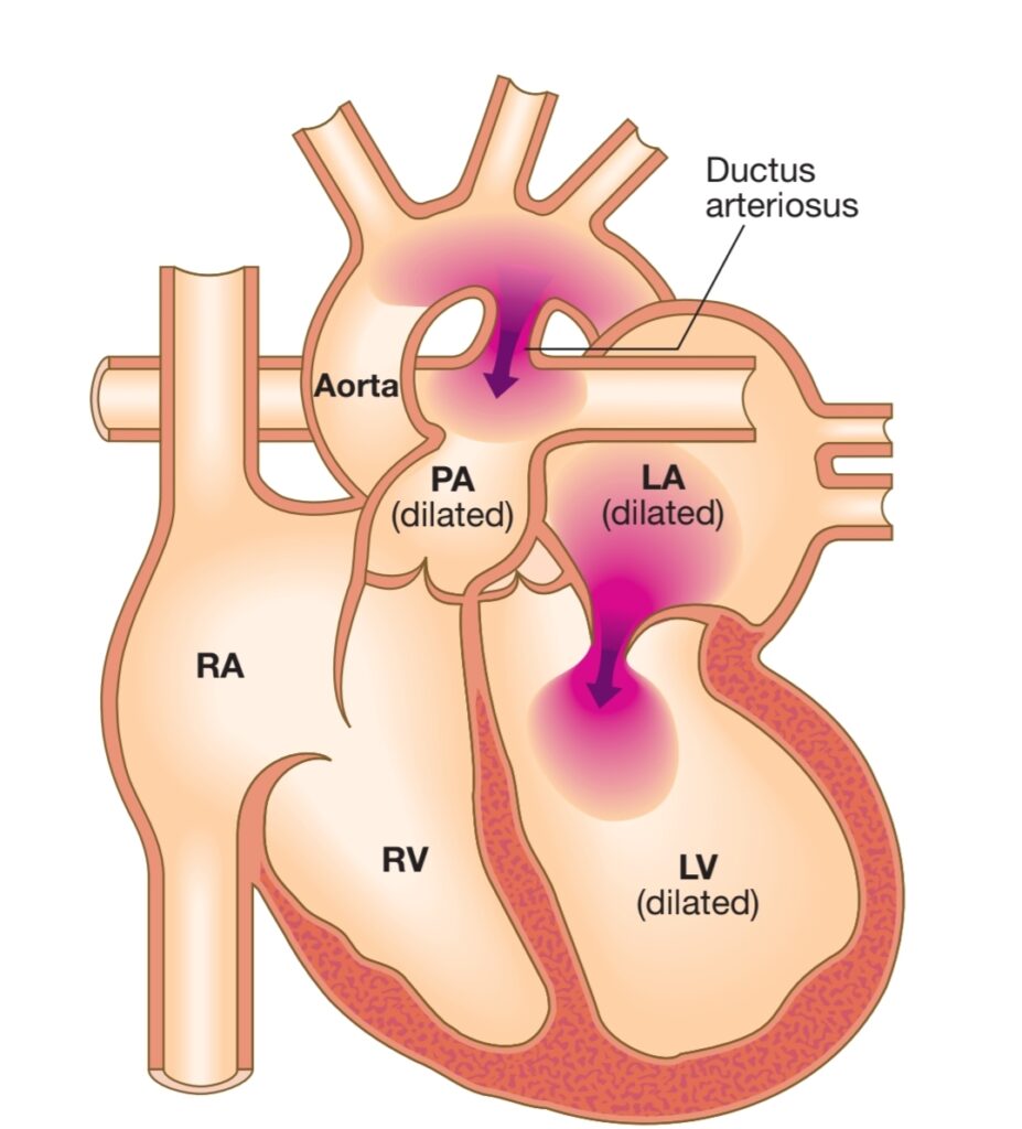 PATENT DUCTUS ARTERIOSUS (PDA)
