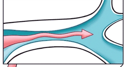 Pulmonary hypertension