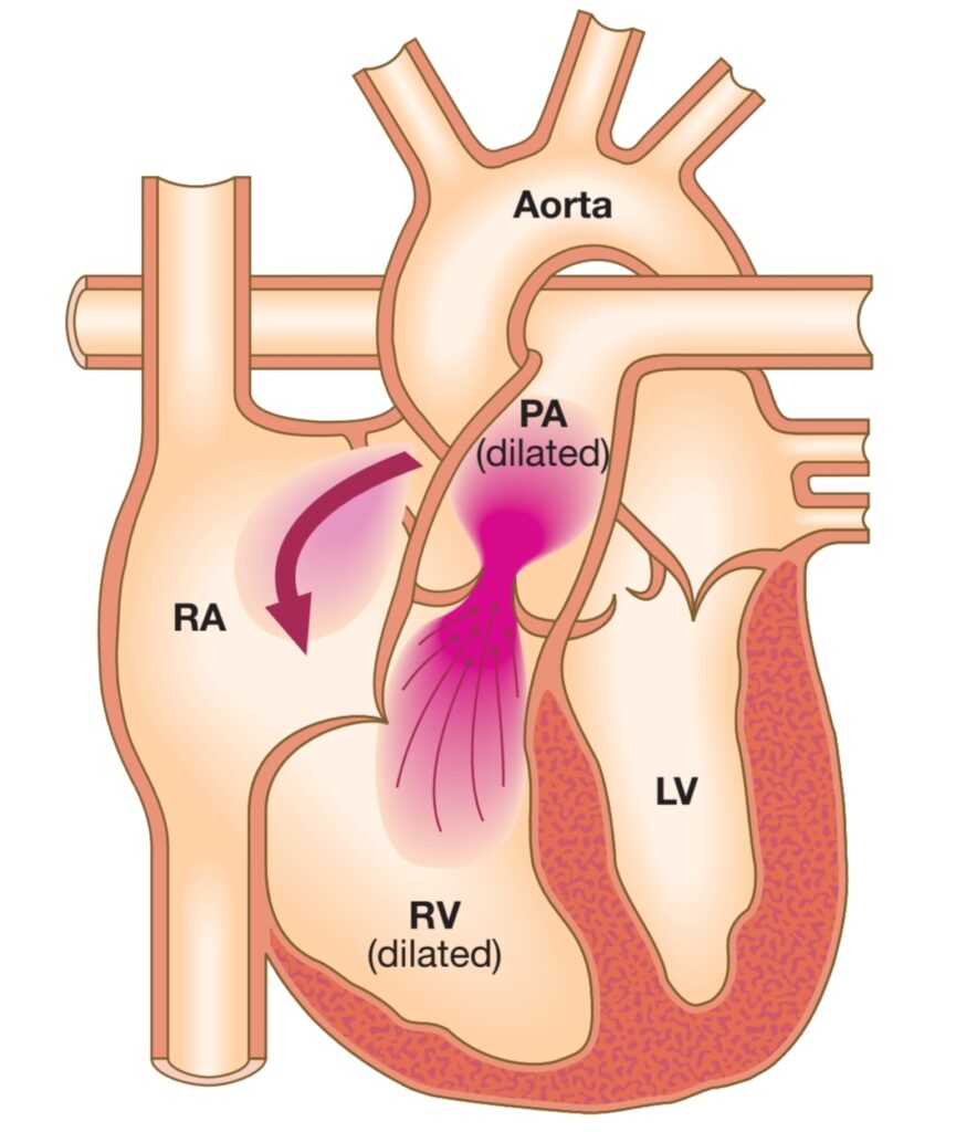 ATRIAL SEPTAL DEFECT (ASD)