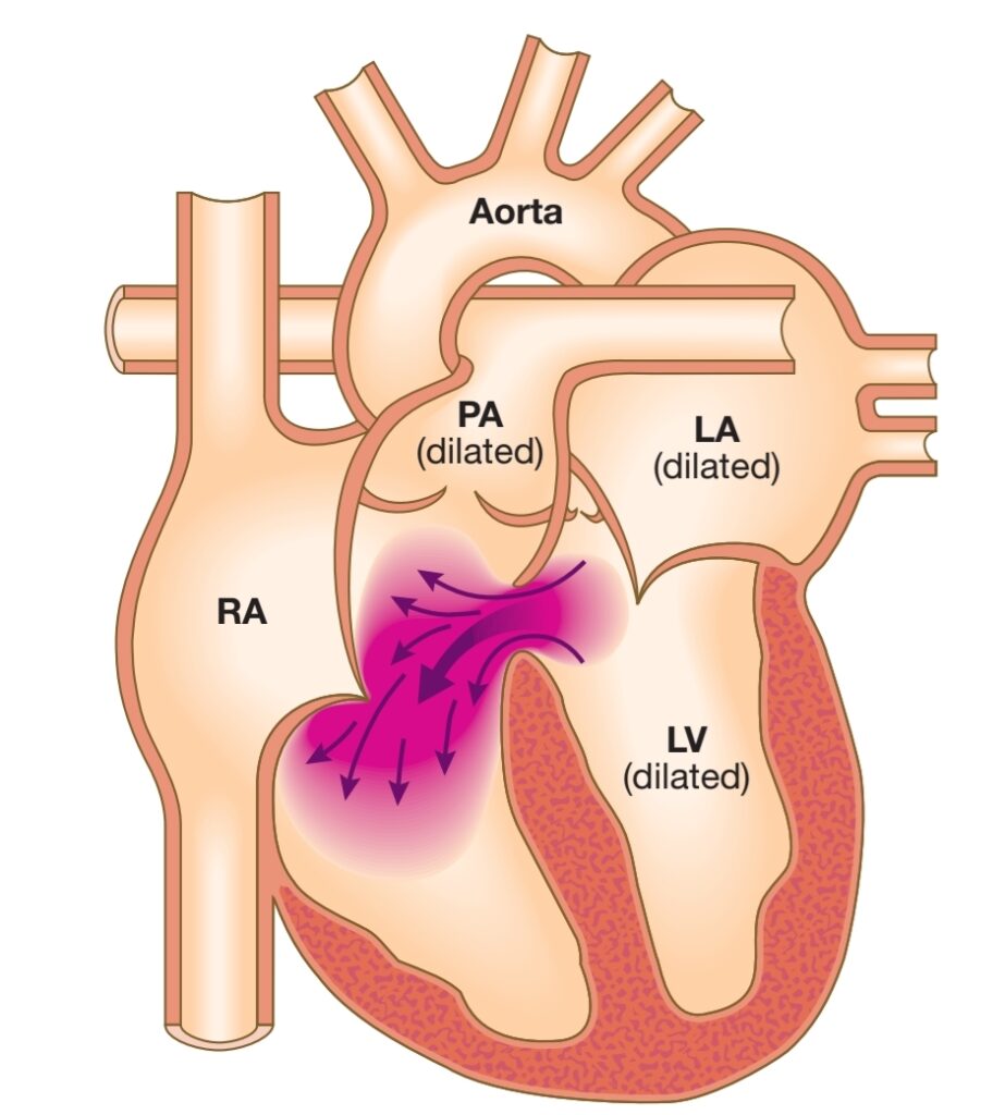 VENTRICULAR SEPTAL DEFECT (VSD)