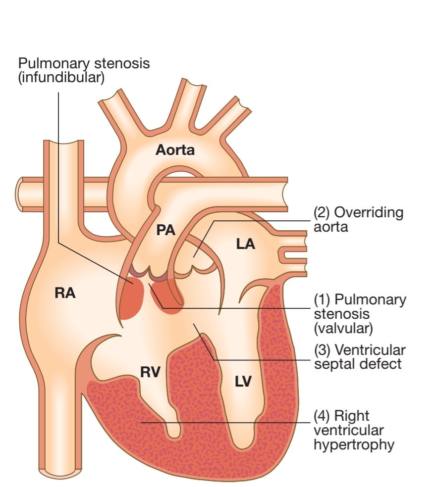 TETRALOGY OF FALLOT