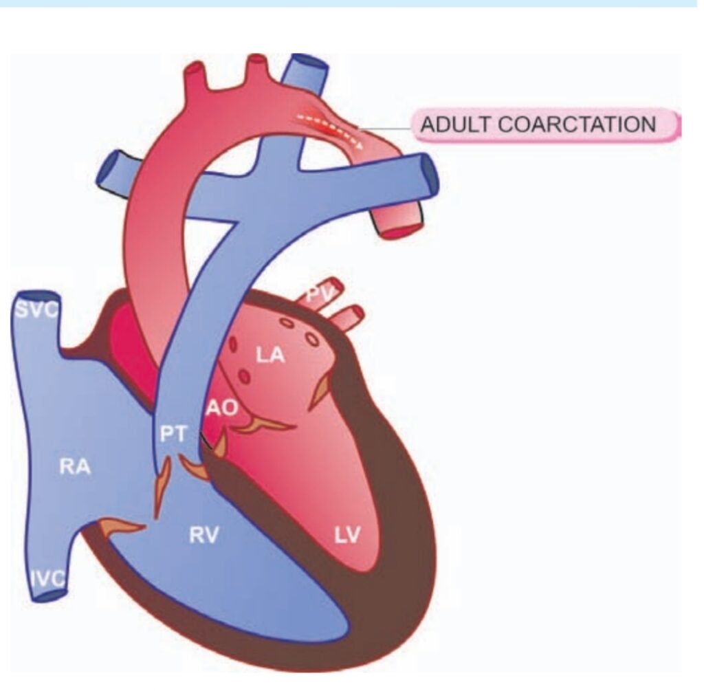COARCTATION OF AORTA