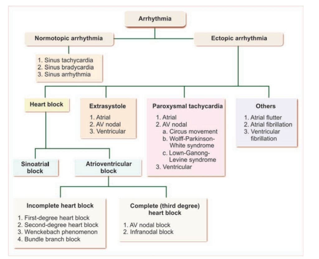 Classification of arrhythmia.