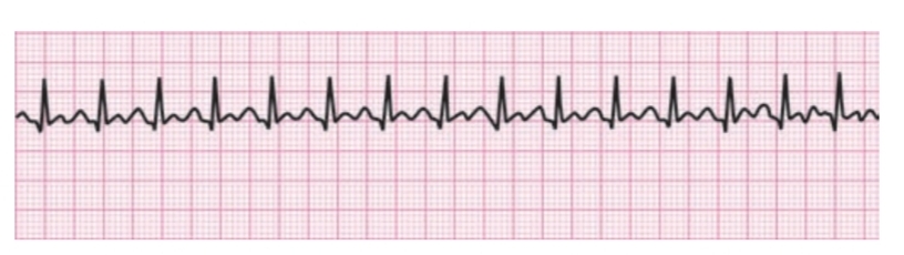 ECG in sinus tachycardia. Normal P-QRS-T. R-R interval is shortened. Heart rate is more than 100/min