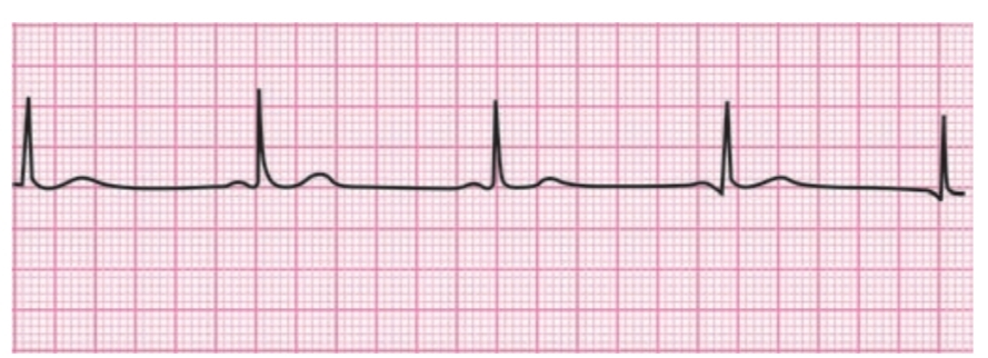 ECG in sinus bradycardia. Normal P-QRS-T. R-R interval is prolonged. Heart rate is less than 60/min.
