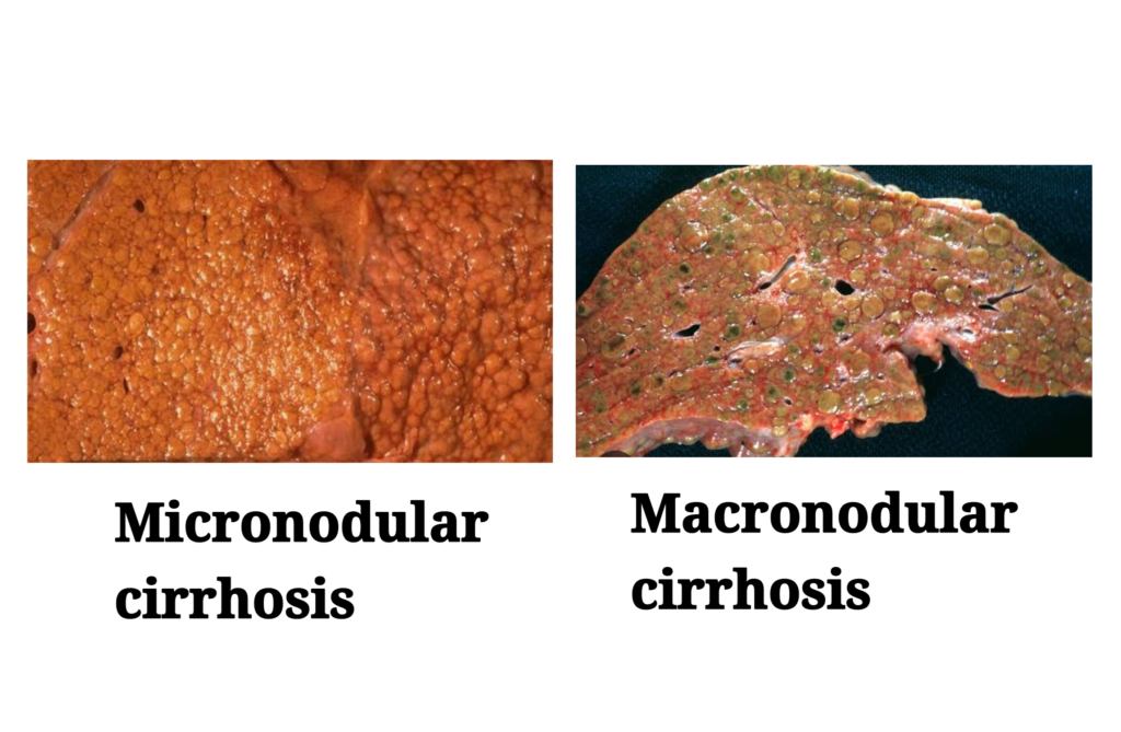 Micronodular cirrhosis and Macronodular cirrhosis,