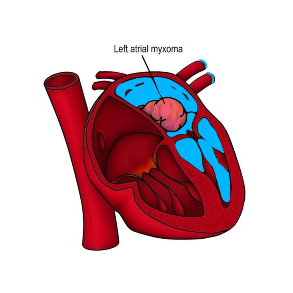 Cardiac tumours , cardiac tumor