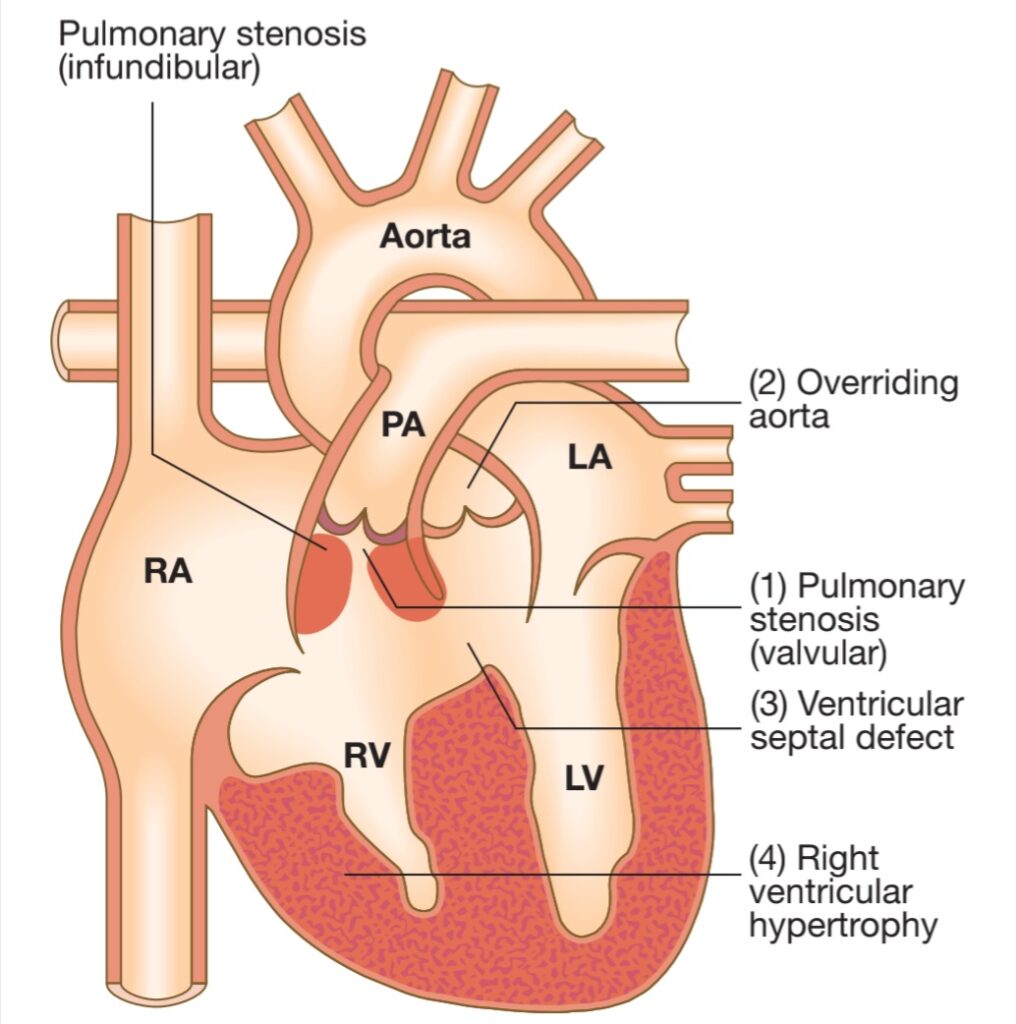 The tetralogy comprises 1. Ventricular septal defect, 2. Obstruction of the right ventricular outflow tract, 3. Override of the ventricular septum by the aortic root,  4. Right ventricular hypertrophy.