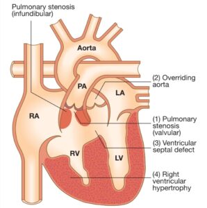 The tetralogy comprises 1. Ventricular septal defect, 2. Obstruction of the right ventricular outflow tract, 3. Override of the ventricular septum by the aortic root,  4. Right ventricular hypertrophy.