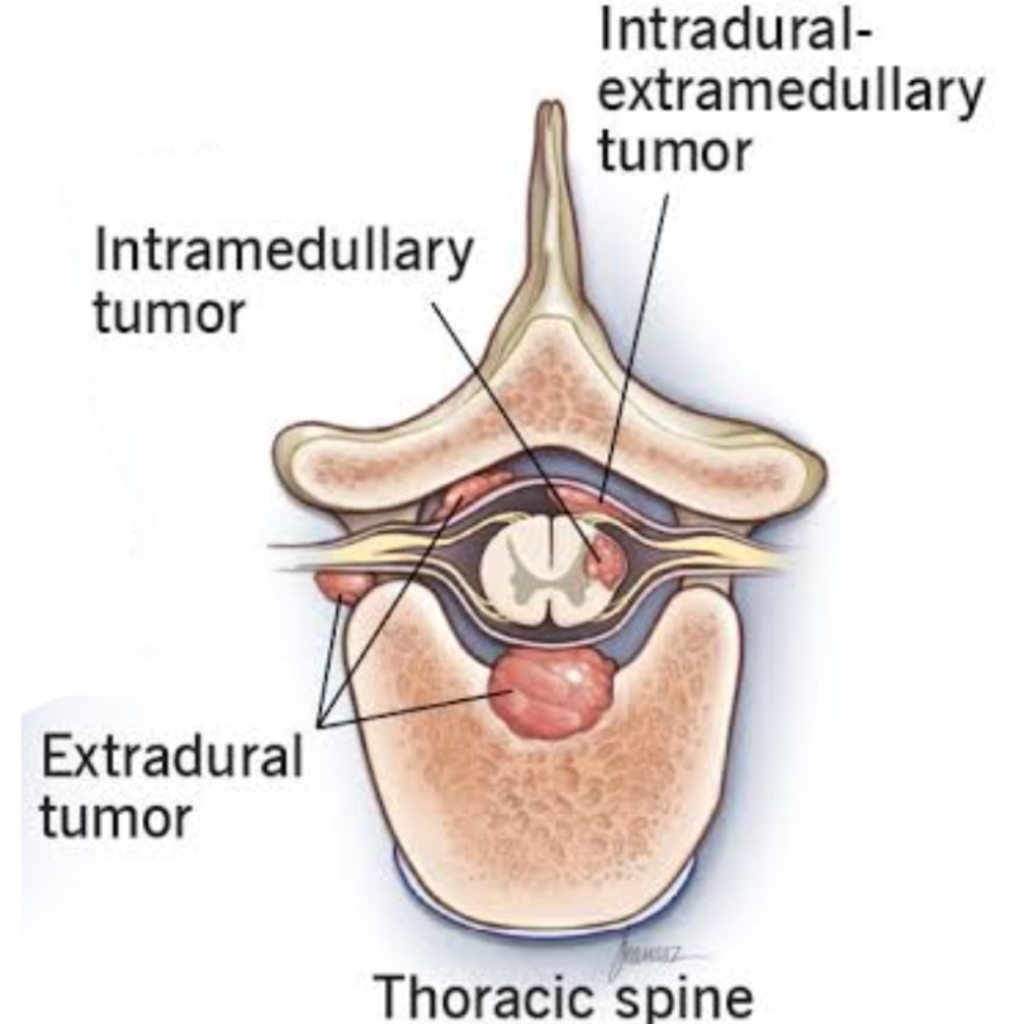 Tumor: REASON for Back Pain