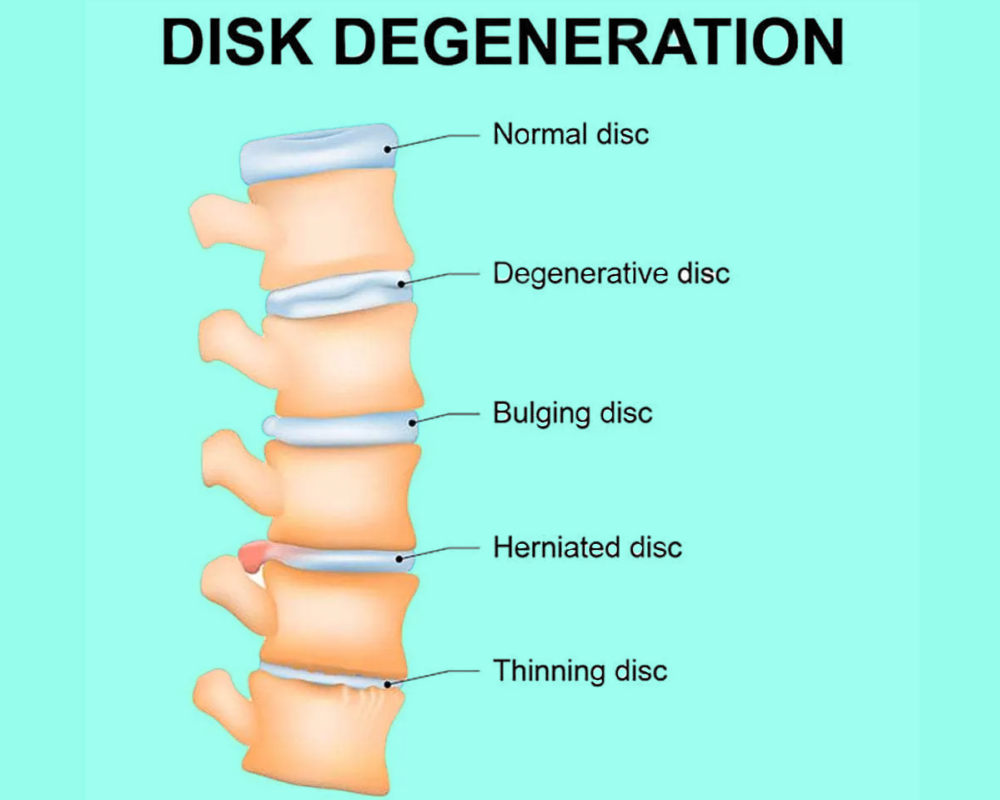 Disk degeneration , the major reason for back pain.