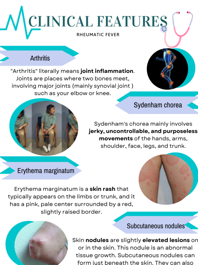 Poster on Clinical feature of Rheumatic fever