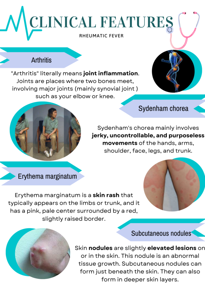 Poster on Clinical feature of Rheumatic fever