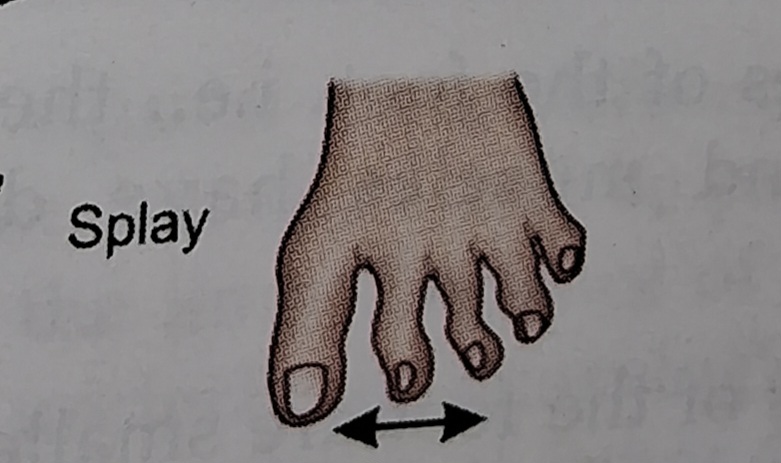 Splay foot deformity