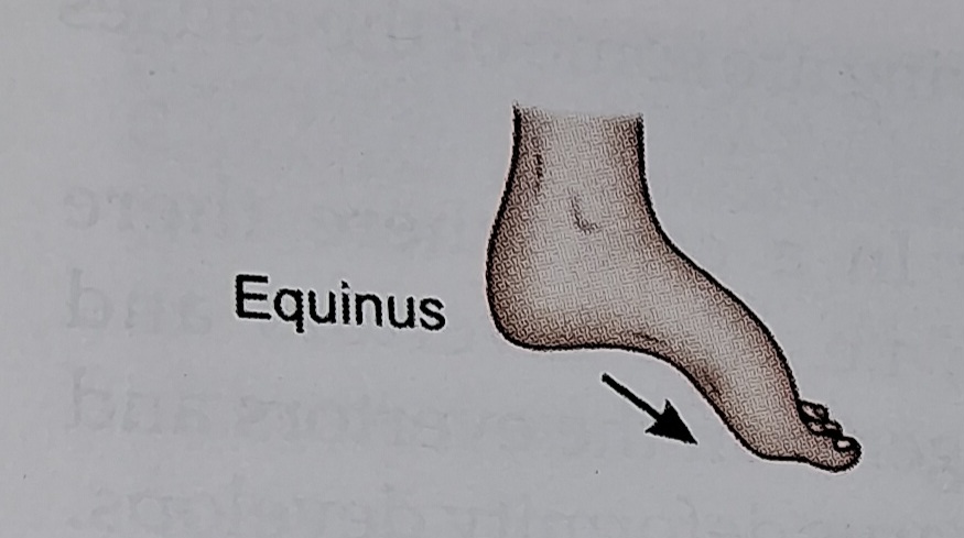 Equinus foot deformity