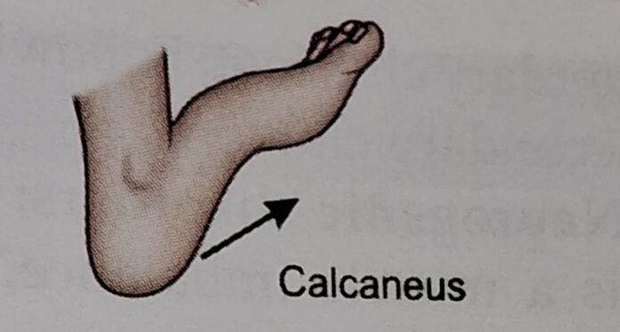 Calcaneus foot deformity