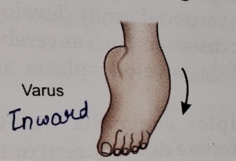 Varus foot deformity