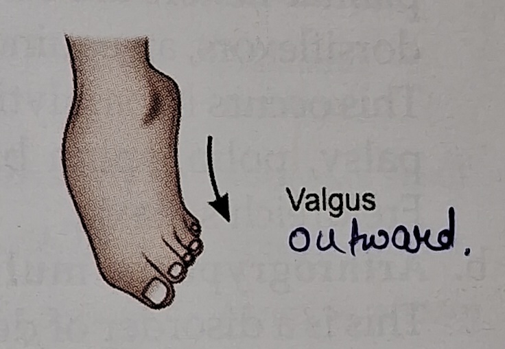 Valgus foot deformity