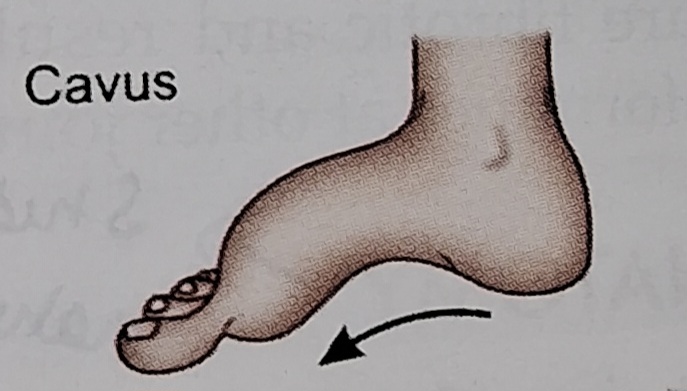 Cavus foot deformity
