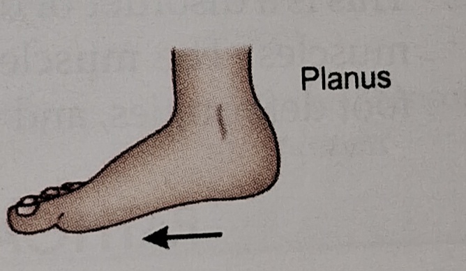 Planus foot deformity