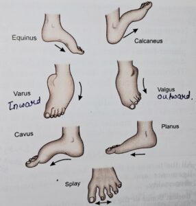 All different type of foot deformity