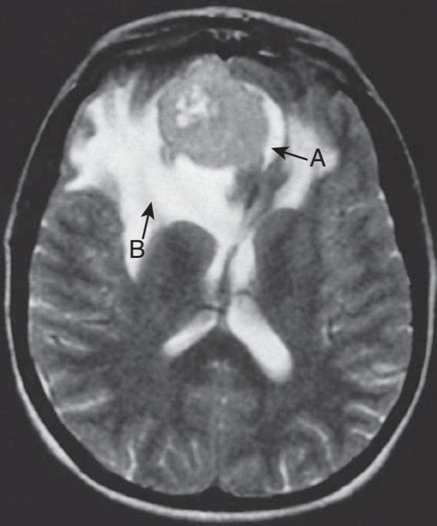 MRI showing a meningioma (brain tumor )