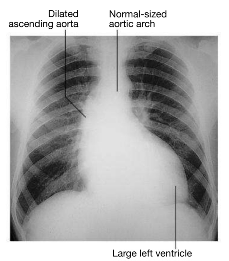 Chest X- ray of a patient with mitral stenosis and regurgitation indicating enlargement of the LA and prominence of the pulmonary artery trunk.