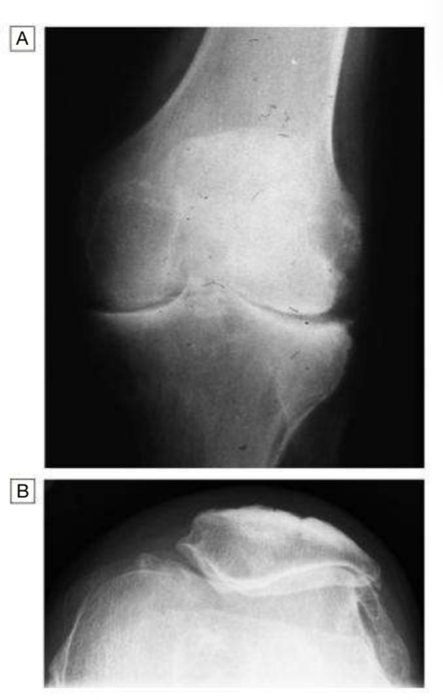 X-ray appearances in Knee osteoarthritis