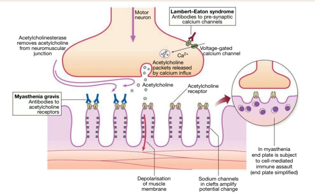 Myasthenia gravis : Antibodies to acetylcholine receptors