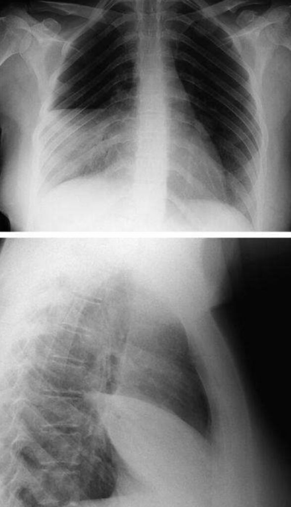 Pneumonia of the right middle lobe. A Posteroanterior view: consolidation in the right middle lobe with characteristic opacification beneath the horizontal fissure and loss of normal contrast between the right heart border and lung. B Lateral view: consolidation confined to the anteriorly situated middle lobe