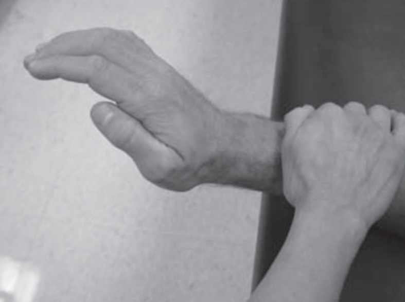 Extension ,Grades 3/5 to +2/5:MMT of wrist joint