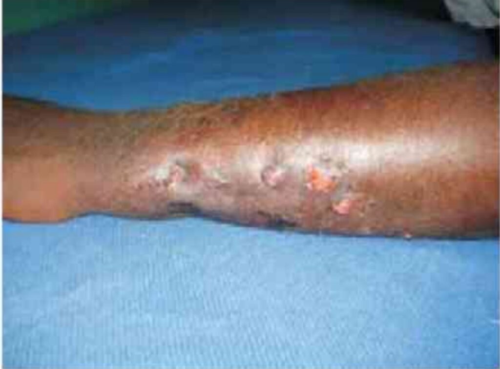 Osteomyelitis