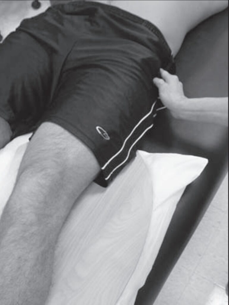 Grades 1/5 to 0/5 of Hip Abduction