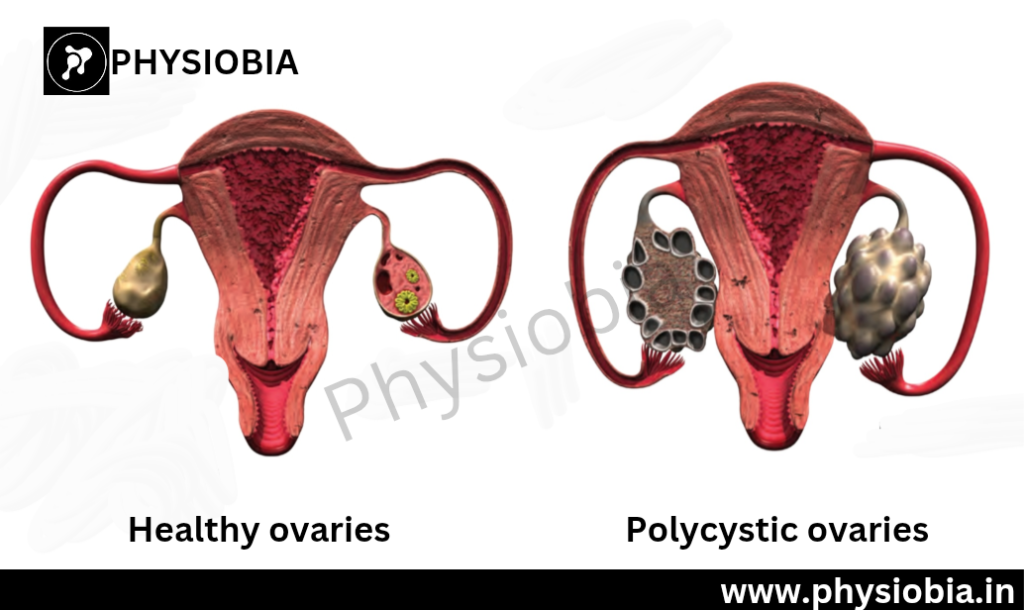 Polycystic ovaries