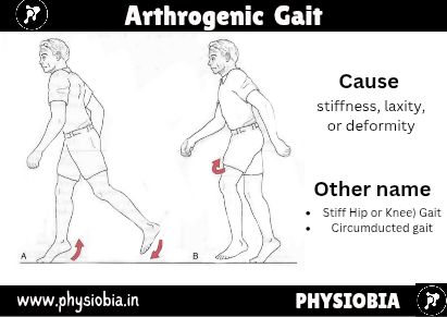 Arthrogenic (Stiff Hip or Knee) Gait