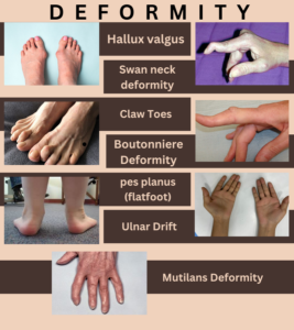 Deformity of rheumatoid arthritis
