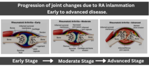 Progression-of-joint-changes-due-to-RA-inlammation_-Early-to-advanced-