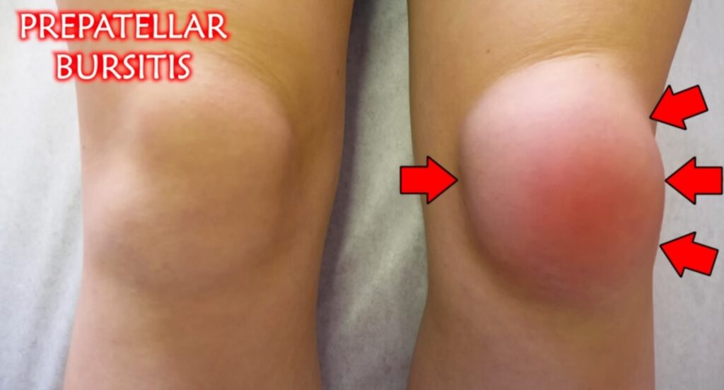 My knee hurt due to patellar bursitis showing knee swelling at the front of knee with aching knees and highlighted pain area